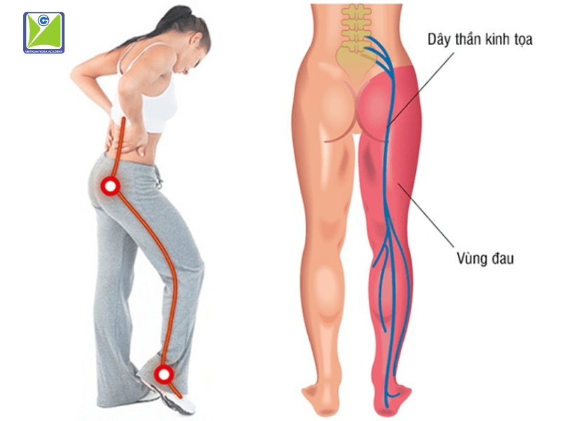 yoga-chua-dau-than-kinh-toa-nhu-the-nao